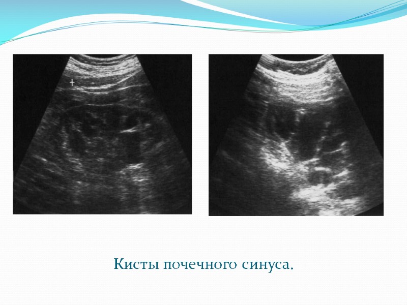 Кисты почечного синуса.